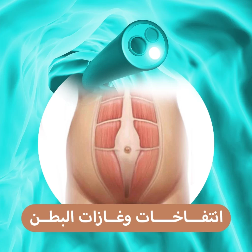 انتفاخات وغازات البطن: أسباب سريعة وحلول منزلية فعّالة, image size:1024x1024