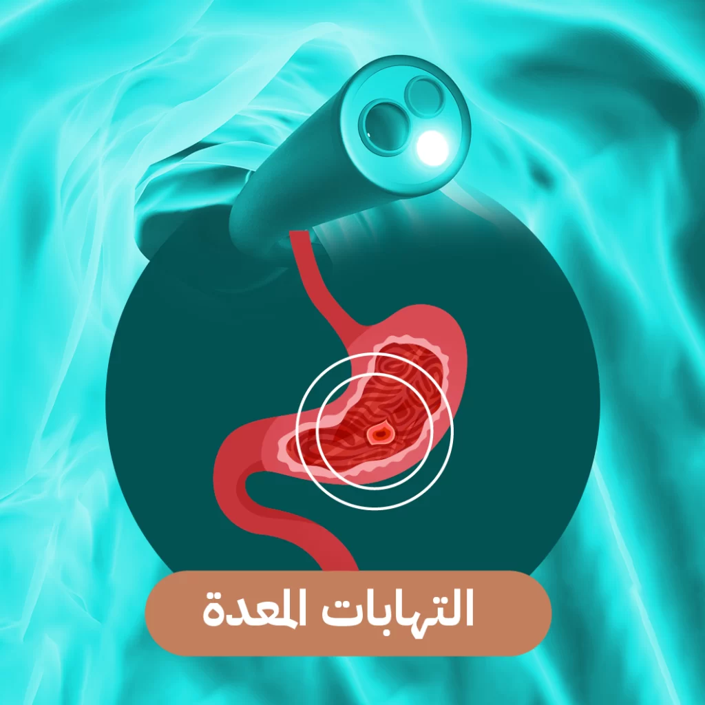 التهابات المعدة