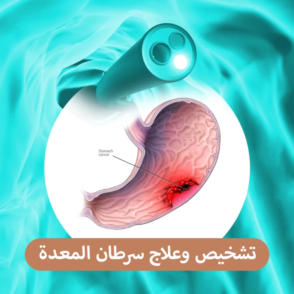 تشحيص وعلاج سرطان المعدة