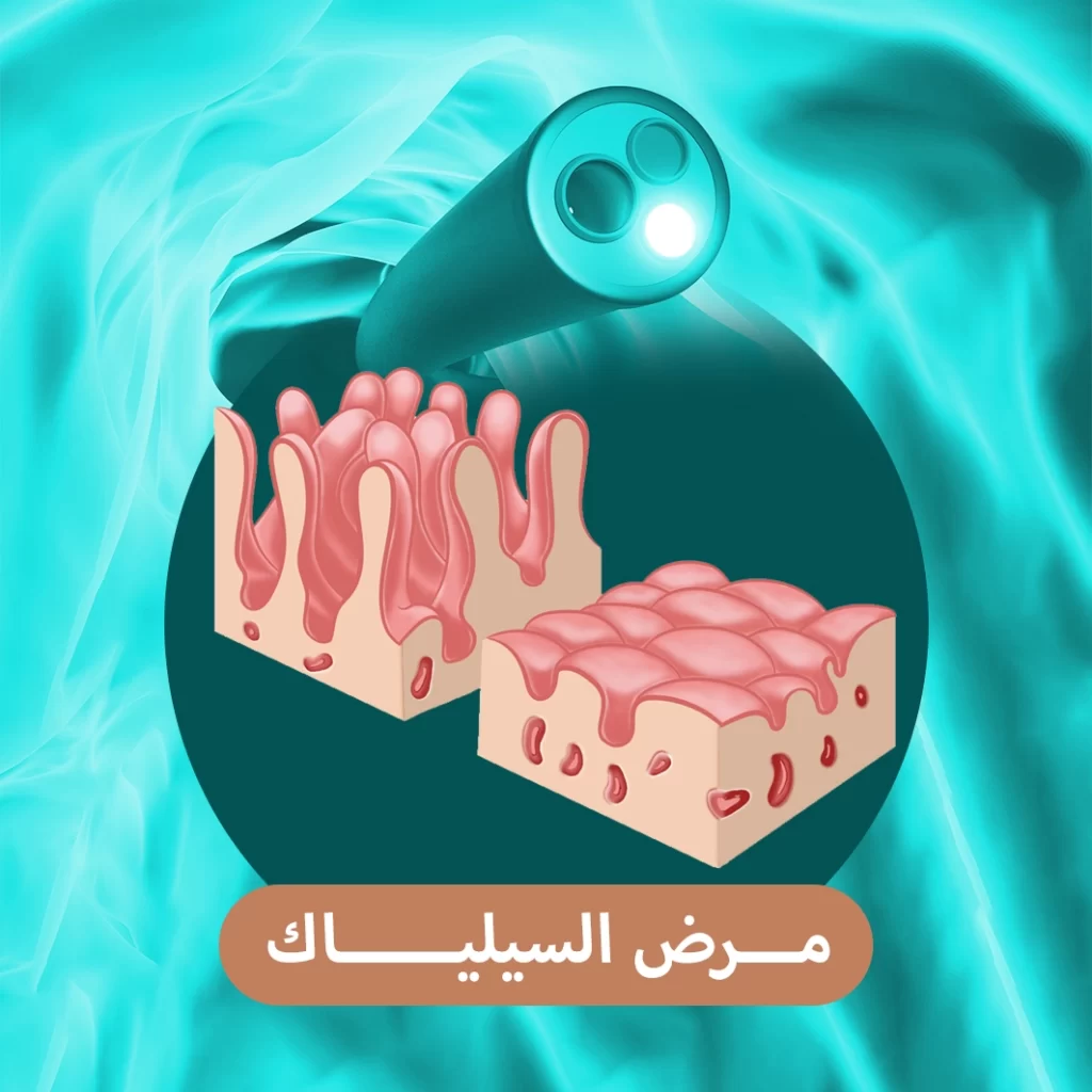 مرض السيلياك