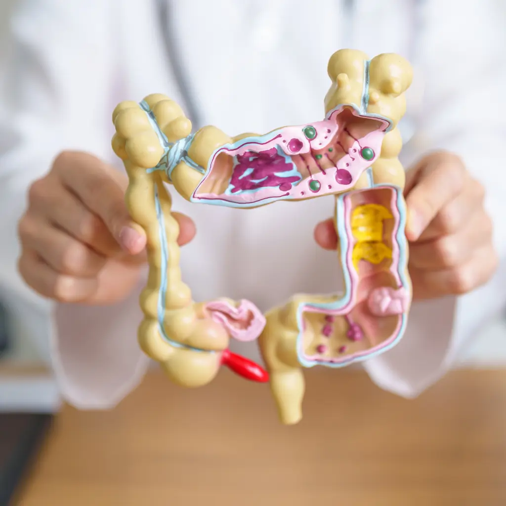 علاج القولون التقرحي