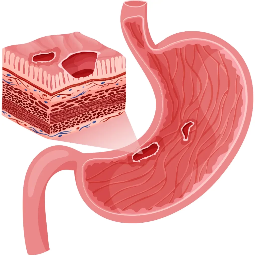 علاج قرحة المعدة بالمنظار بالتفصيل, image size:1024x1024