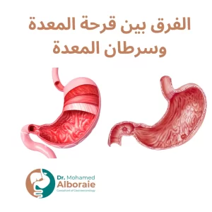 الفرق بين قرحة المعدة وسرطان المعدة