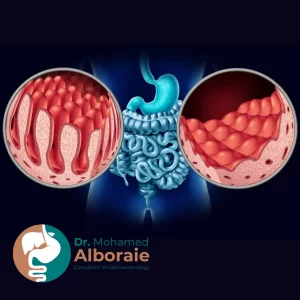 أعراض السيلياك عند الكبار والنساء والأطفال