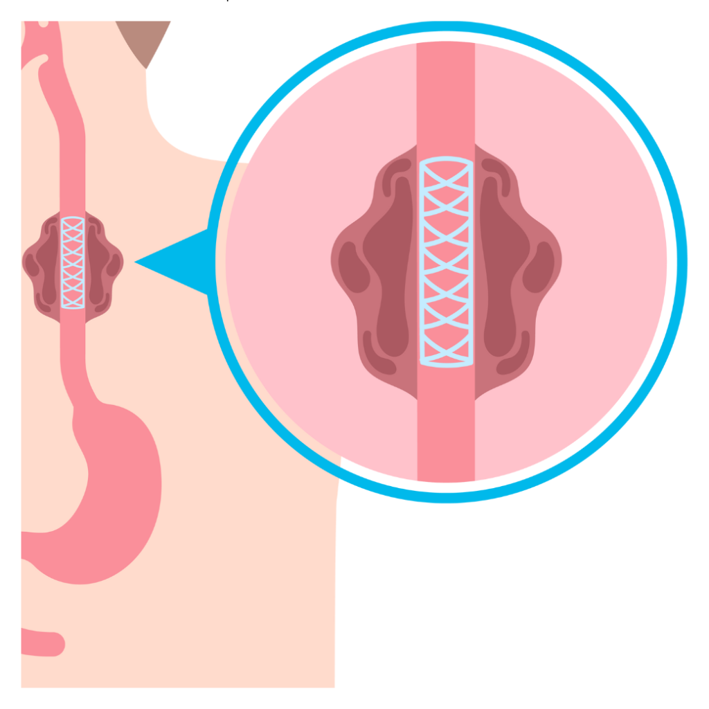 حالات شفاء من سرطان المريء
