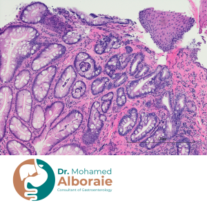نسبة الشفاء من سرطان المريء