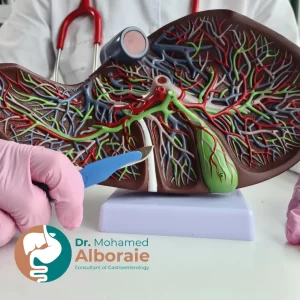 أعراض توسع القناة الصفراوية