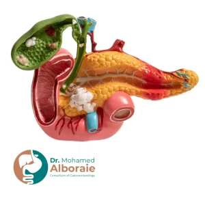 سرطان القناة الصفراوية