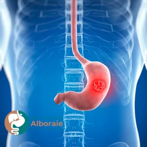 ماهي أعراض سرطان المعدة المبكرة