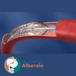 عمليات تركيب دعامة في القنوات المرارية