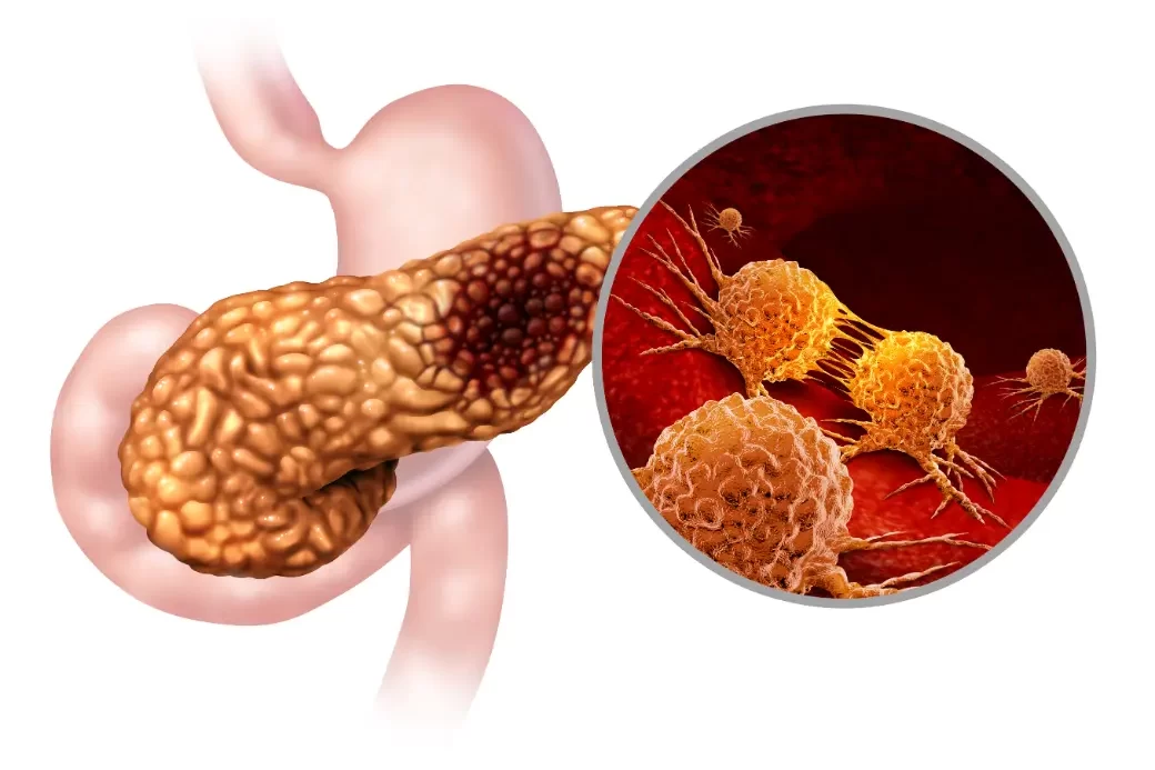 ما الفرق بين التهاب البنكرياس وسرطان البنكرياس من حيث الأعراض