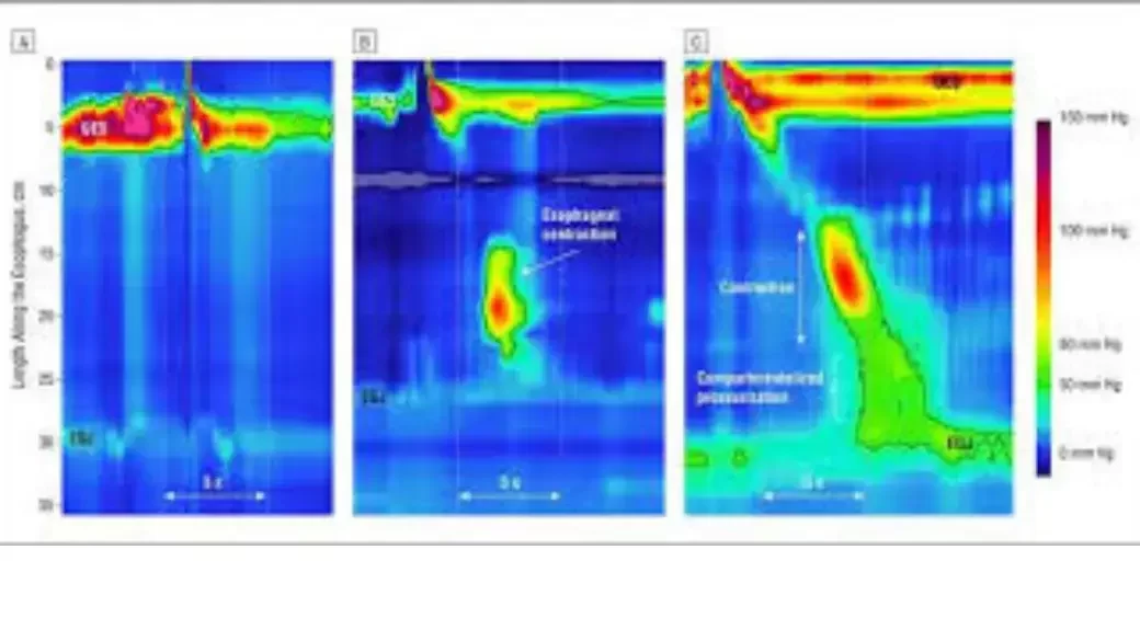 قياس حركية المريء