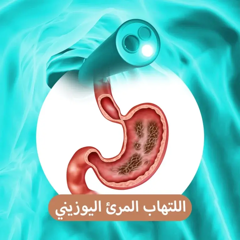 التهاب المريء اليوزيني