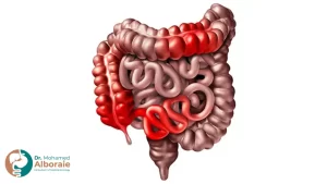 أسباب مرض كرونز