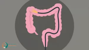 أضرار منظار القولون