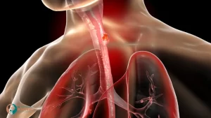 استئصال اورام المرئ بالمنظار