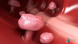 أعراض زوائد لحمية في القولون